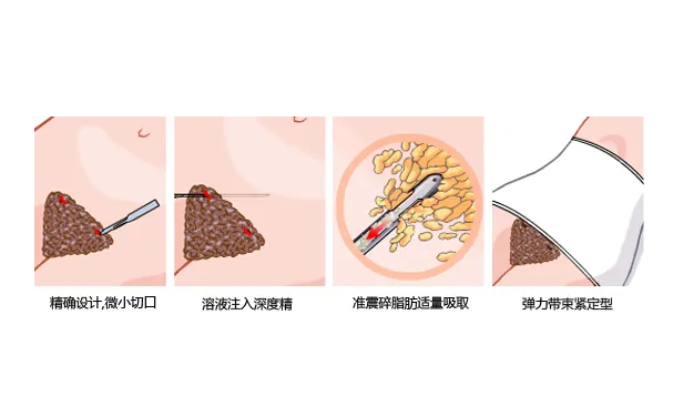 佛山順德壹加壹美容醫(yī)院共振吸脂技術(shù)級別怎么樣?案例點(diǎn)評&費(fèi)用明細(xì)
