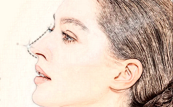 湖南禾信植發(fā)頭發(fā)種植一年案例反饋(效果怎么樣?技術(shù)亮點(diǎn))