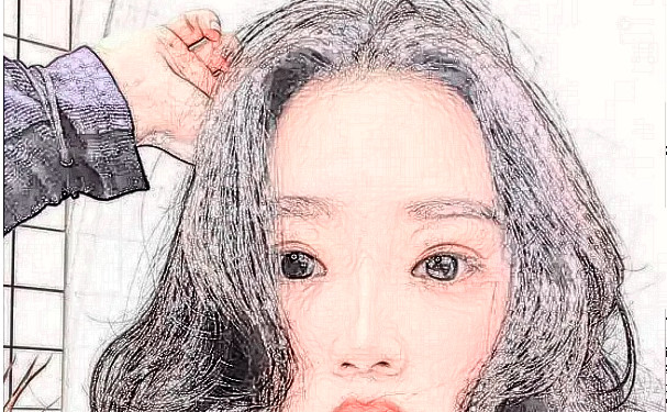 武漢希思特醫(yī)療美容醫(yī)院植發(fā)技術(shù)評(píng)價(jià)怎么樣?一年案例恢復(fù)過程