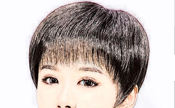 岳陽愛思特醫(yī)療美容門診部植發(fā)半年術(shù)后案例反饋&費(fèi)用明細(xì)?