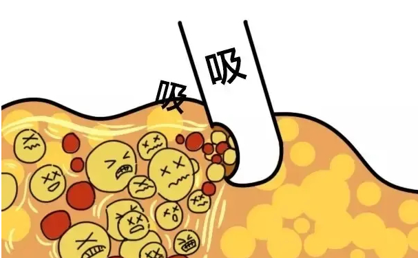 北京貴美匯醫(yī)院脂肪填充報價多少?技術優(yōu)點怎么樣?