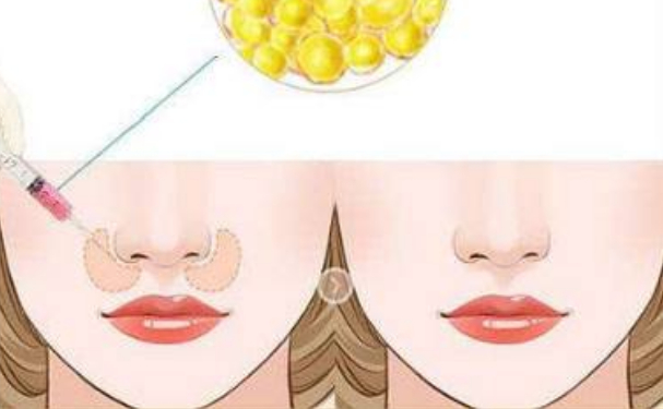 宜昌市中心人民醫(yī)院膠原蛋白填充鼻唇溝醫(yī)生排名,費(fèi)用明細(xì)?心動(dòng)案例