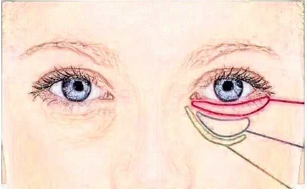 上海九院王智超消除眼袋手術(shù)技術(shù)特色怎么樣?案例欣賞