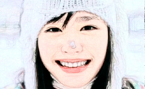 鄭州大學(xué)第一附屬醫(yī)院鄭東院區(qū)唐曉娟去眼角細(xì)紋案例細(xì)節(jié)&價格一覽表?